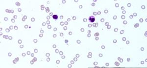 Read more about the article Thrombotic Thrombocytopenic Purpura At High Altitude