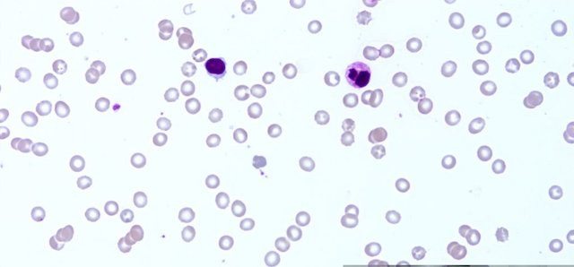 Thrombotic thrombocytopenic purpura