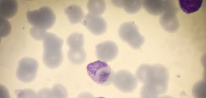 Read more about the article Travel Precautions For High Eosinophil Count