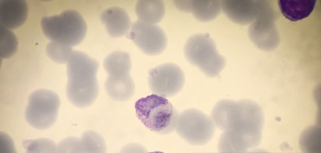 High eosinophil count