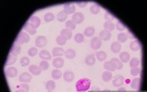 Read more about the article High Eosinophil Count In Air Travellers