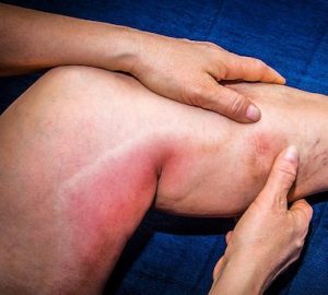 Read more about the article Thrombus Risk Rises With Long Flights