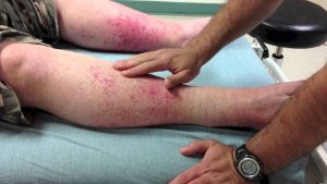 Read more about the article Vasculitis Meaning Explained For Space Missions