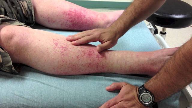 Vasculitis meaning