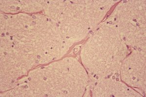 Read more about the article Sickle Cell Disease Risks At Altitude