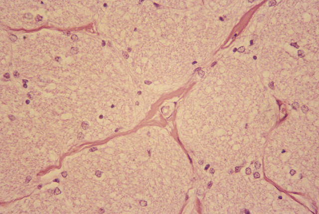 Sickle cell disease